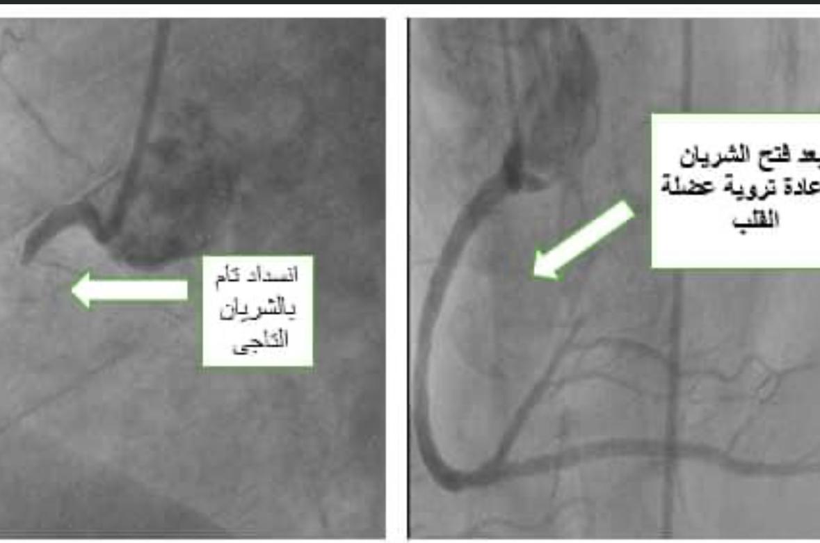 تخصصي بني سويف تنقذ مريض من جلطة